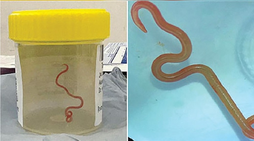 Parasite Extracted from a Woman's Brain