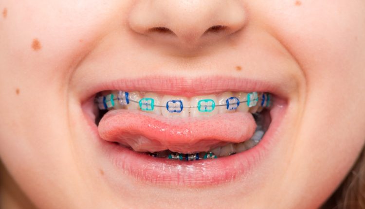 Top 5 Cleaning Techniques for Kids' Braces