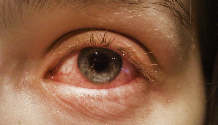 "Conjunctive Virus," its Causes, and Treatment